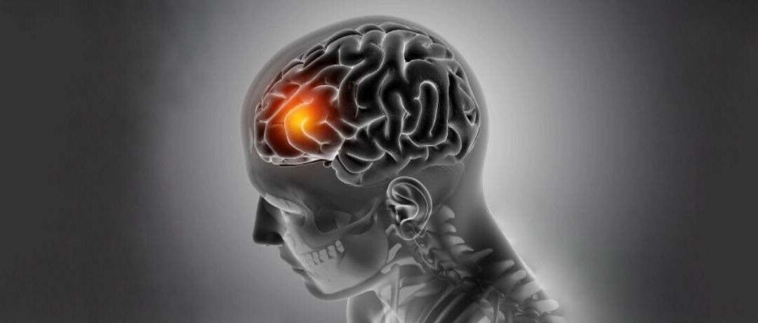 Brain Tumor Surgery by Dr. Alok Srivastava