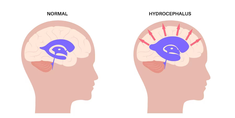 Hydrocephalus: Expert Treatment by Dr. Alok Srivastava, Neurosurgeon in Lucknow