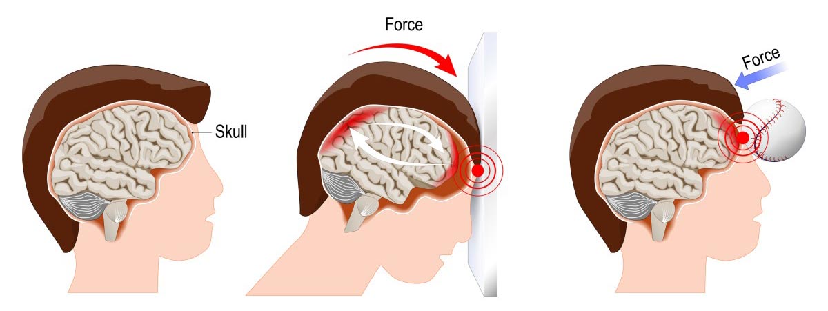 Cranial Trauma Treatment by Dr. Alok Srivastava - Best Neurosurgeon in Lucknow