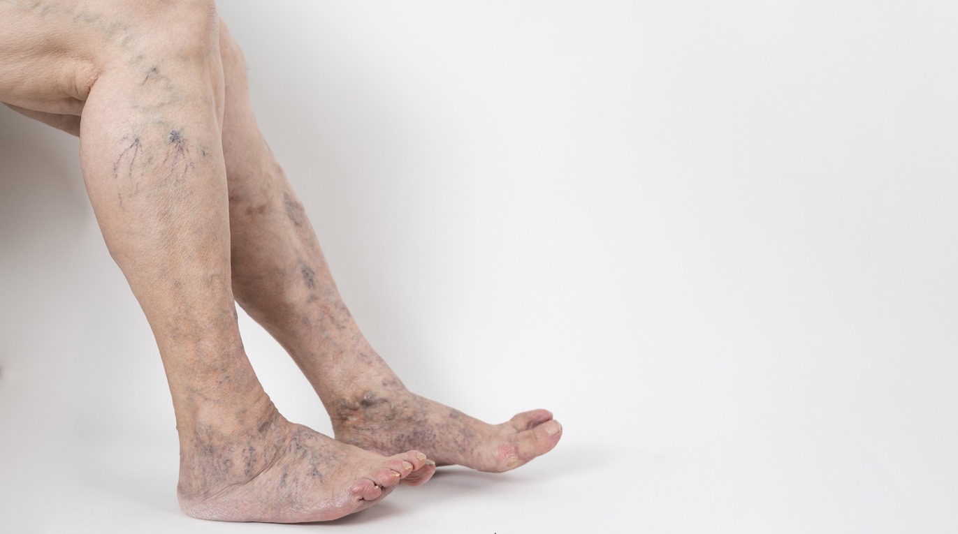 Can a Neurosurgeon Treat Varicose Veins?